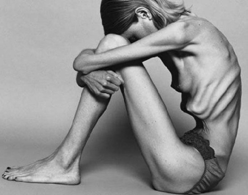anorexia1
